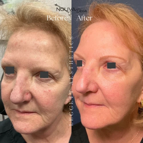 Aging skin