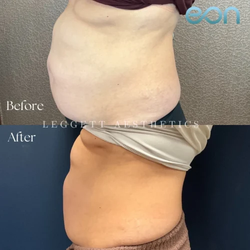 Body Contouring (2)