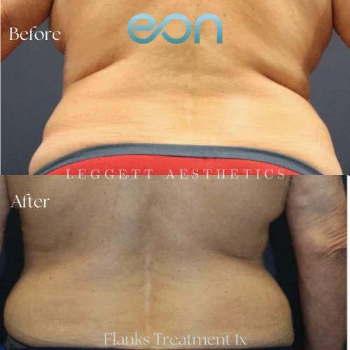 Body Contouring (3)