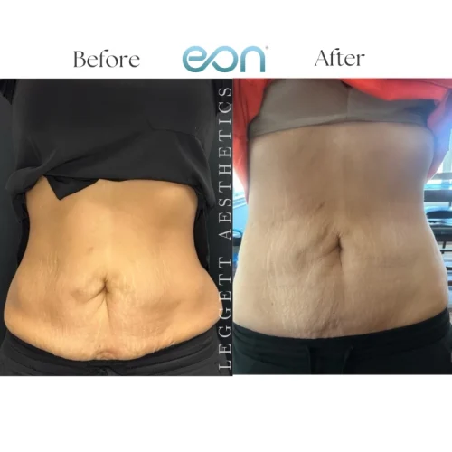 Body Contouring  Skin tightening