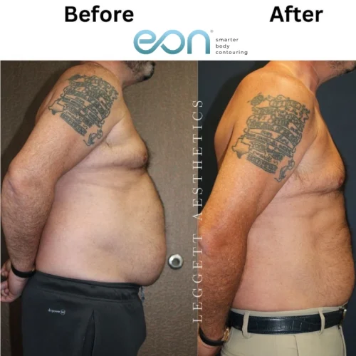 Body Contouring