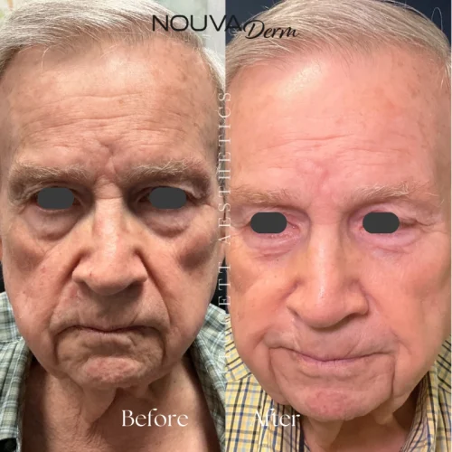 Dark Spots, Wrinkles, Aging Skin