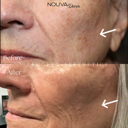 Dark Spots
