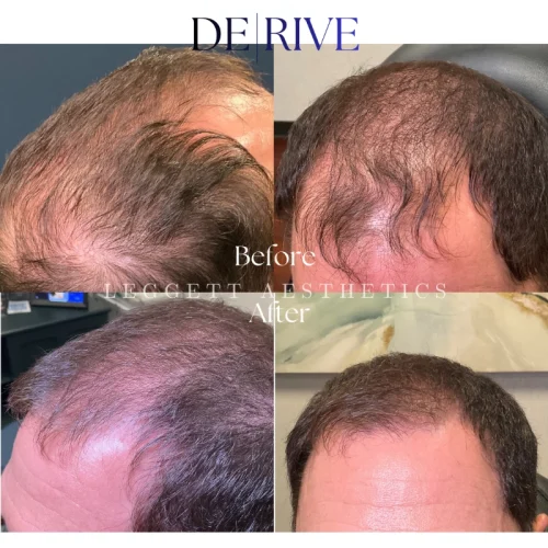 Hair loss