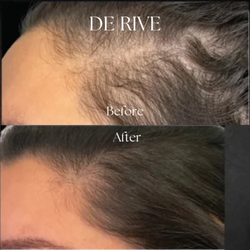 Hairloss