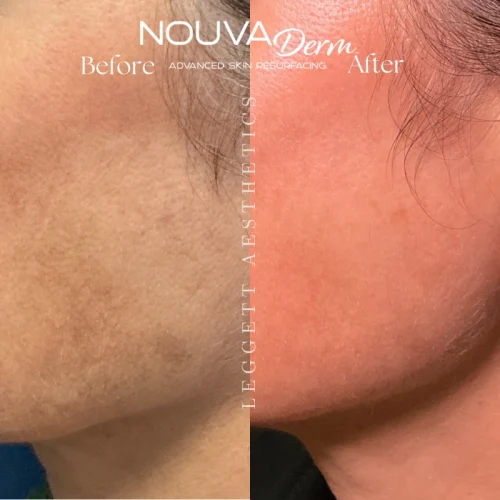 Melasma