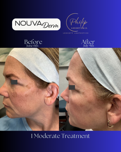 Nouvaderm Frame copy