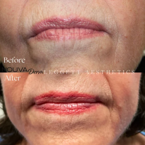Perioral Lines
