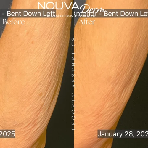 Skin Laxity