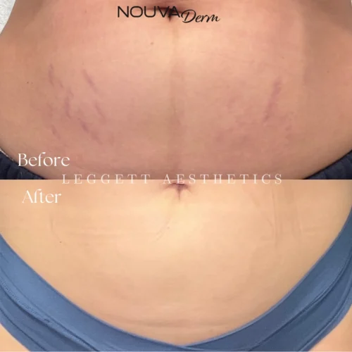 Stretch Marks