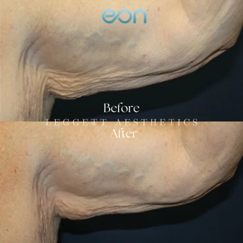 Weight loss_ skin tightening